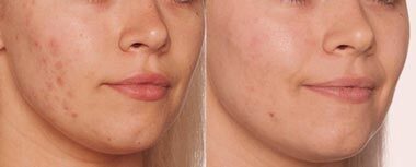crema acné resultados 1 mes de tratamiento